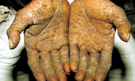 Arsenical Keratosis from: Status of groundwater arsenic contamination in the state of West Bengal India: A 20 year study report via India Environment Portal